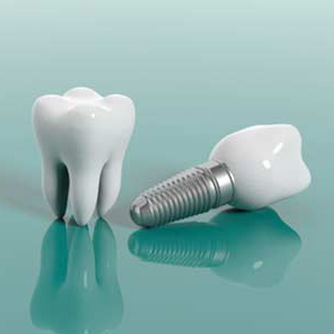 3D images of dental implant structure