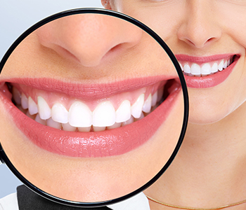 Even though the end result is different for everyone, you will notice a definite improvement in the brightness of your smile after the treatment