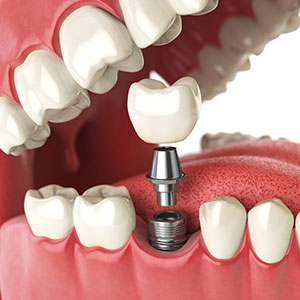 Dental implant procedure from Dr. Gorden Kent in Buffalo NY