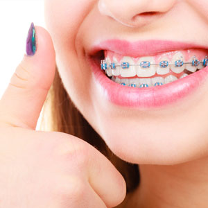Woman smile showing her white teeth with blue braces and giving thumbs up