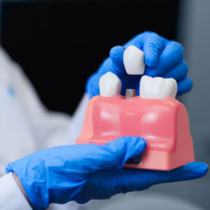Doctor holding model of teeth with dental implant, closeup of tooth implantation