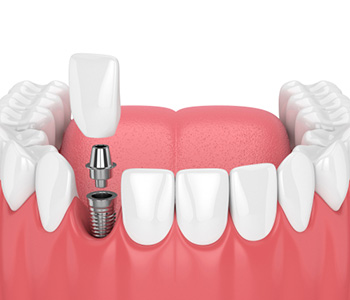 Dental Implants structure in Buffalo area