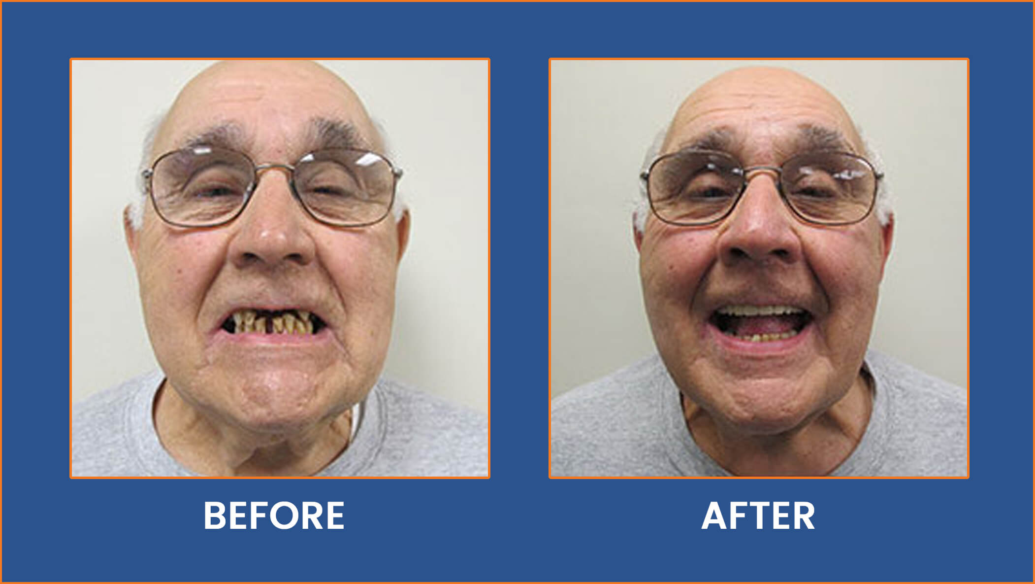 Dental Implants Buffalo, NY