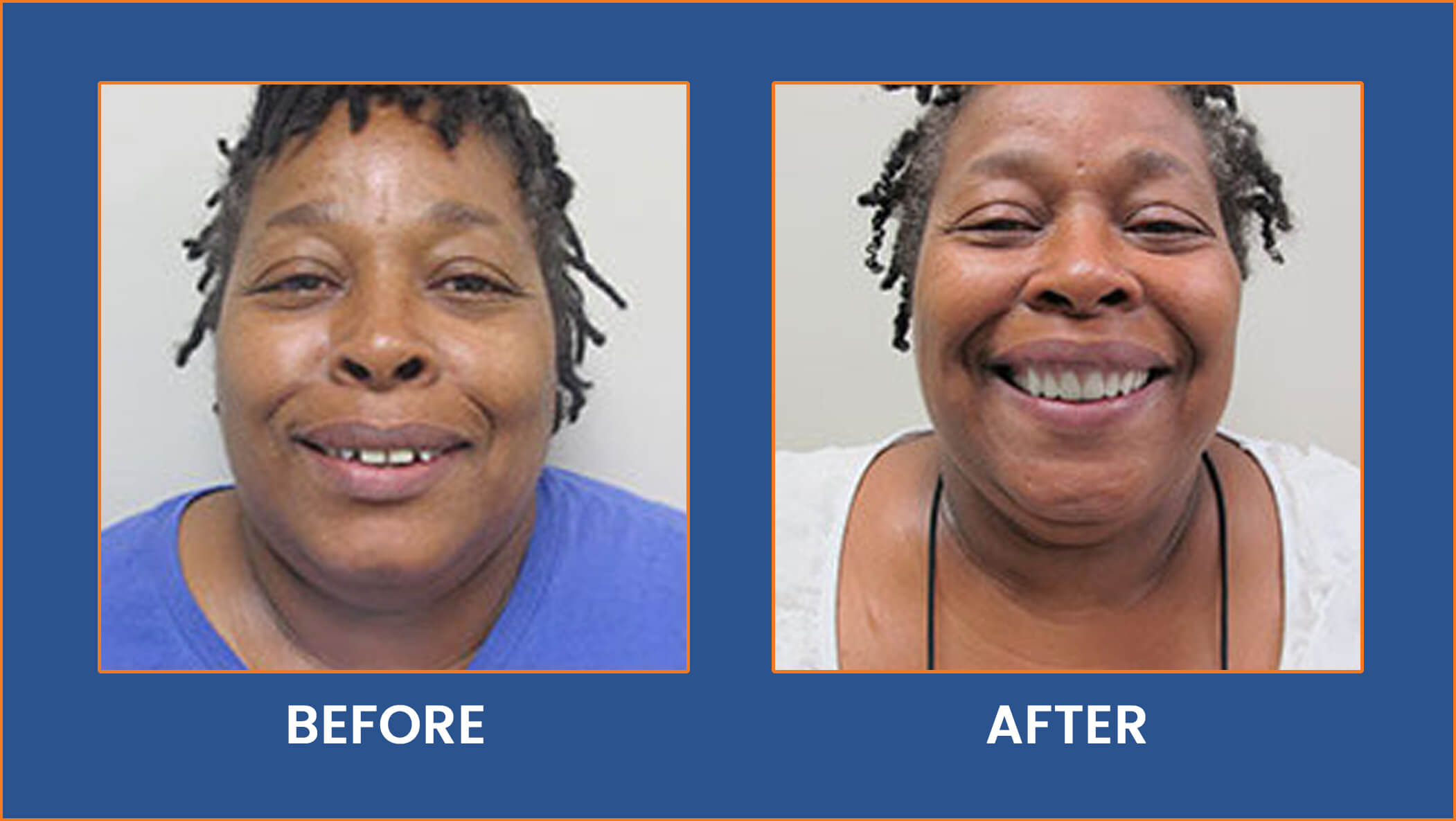 Dental Implants, Cosmetic Dentist Buffalo, NY - Real Patients