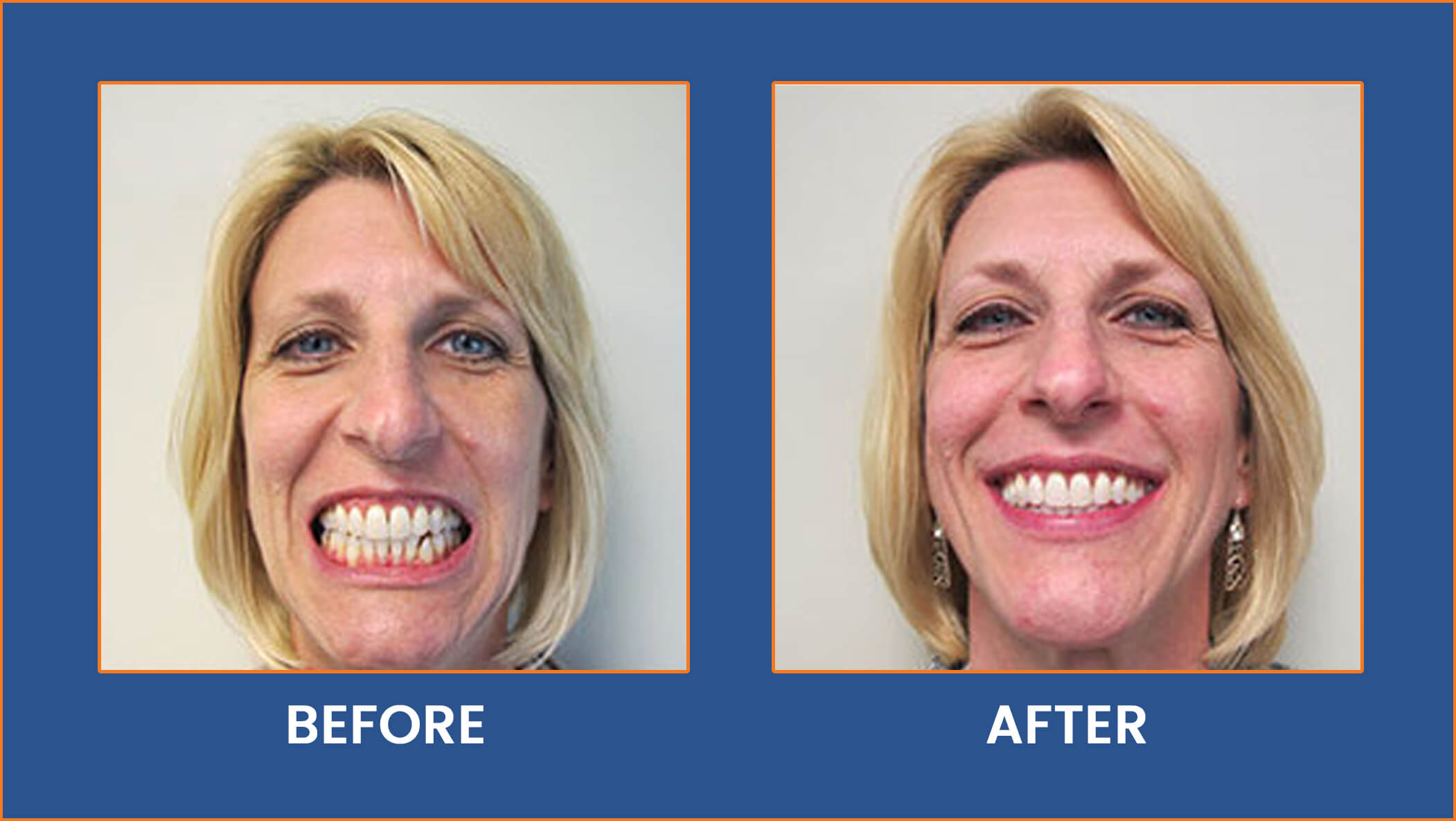 Dental Implants, Cosmetic Dentist Buffalo, NY - Real Patients