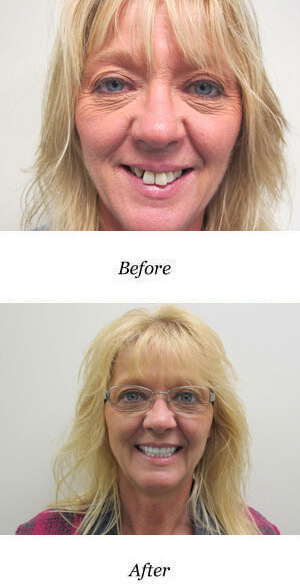 before-after-smile-gallery-image-20